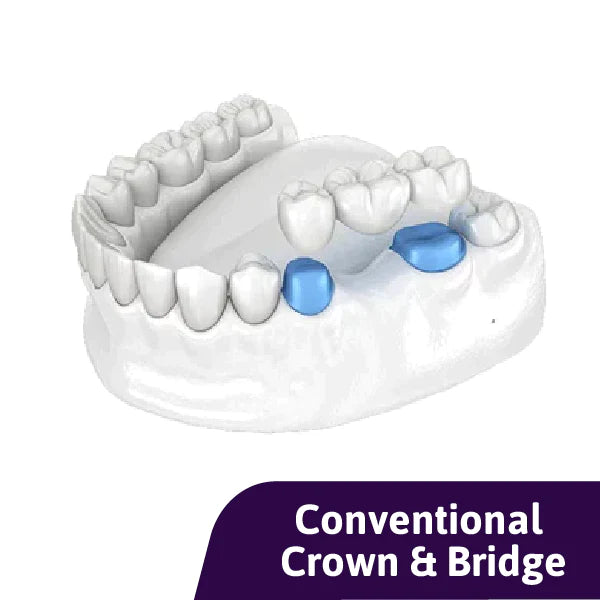 Porcelain Fused Zirconia Conventional Bridge (PFZ)